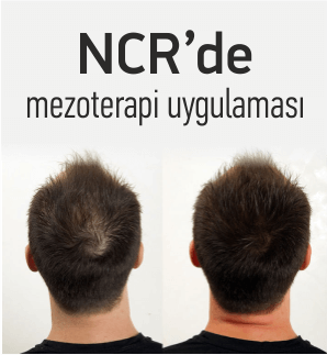 Prof. Dr. Erbağcı: Daha gür saçlar için mezoterapi...